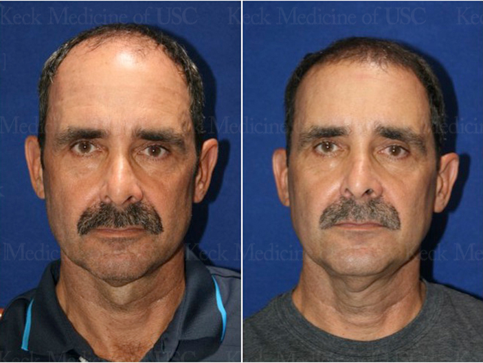 Before-and-after photo of a patient who underwent a hair transplant procedure at Keck Medicine of USC