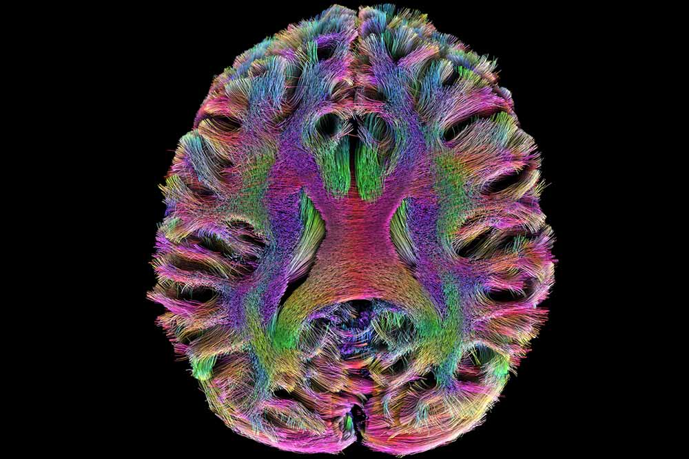 A colorful brain scan.